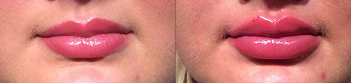 Dermal Filler Ashland KY - Before & After Lower Face and Lip Treatment